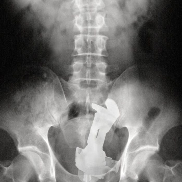 10+ X-rays That Reveal Strange Things in Your Butt