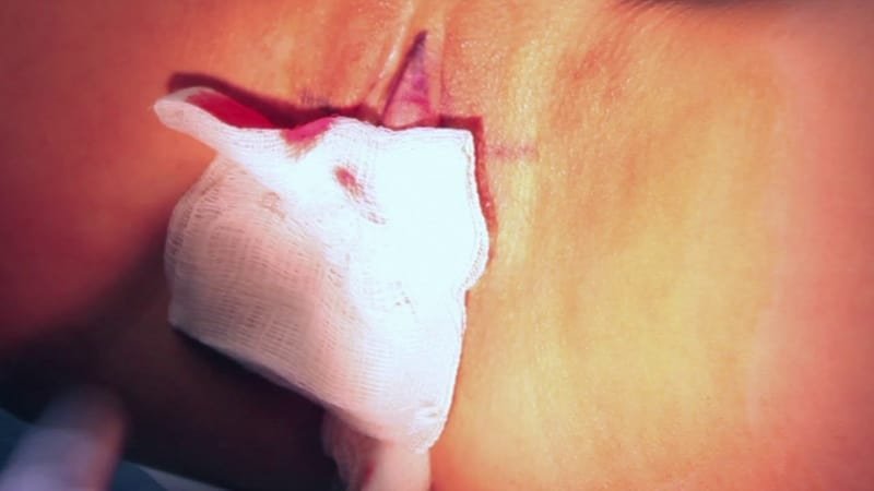 Labiaplasty is popular