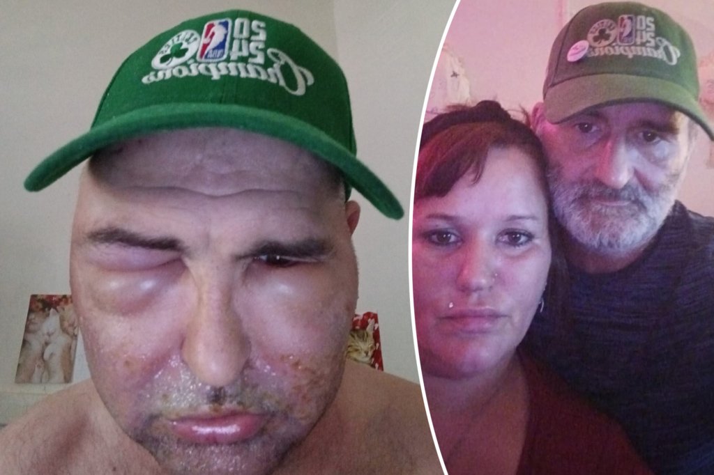 Allergic reaction to beard dye makes man look like a sloth