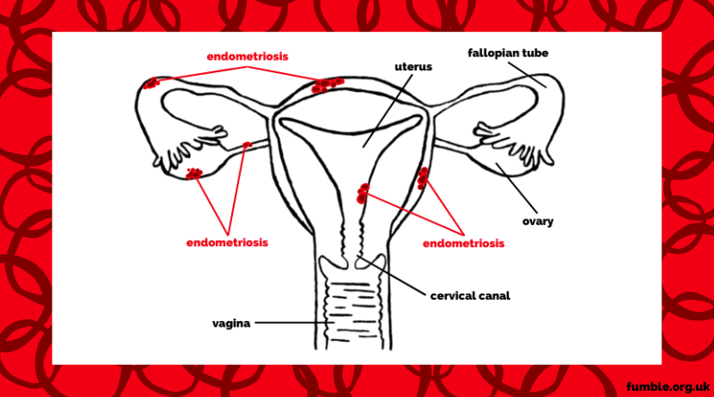 Endometriosis: Is extreme cycle pain normal?